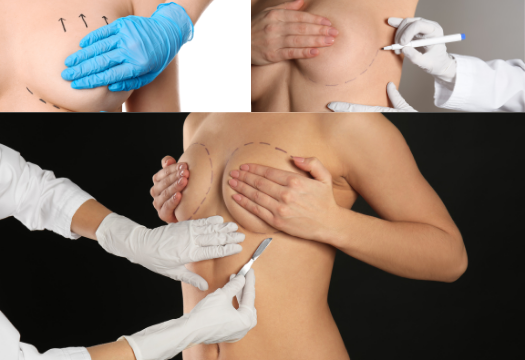 Breast augmentation/lift/reduction