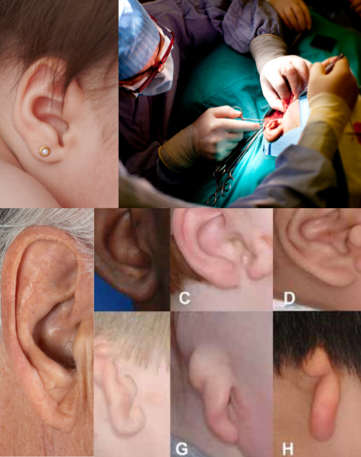 Microtia & Ear deformities